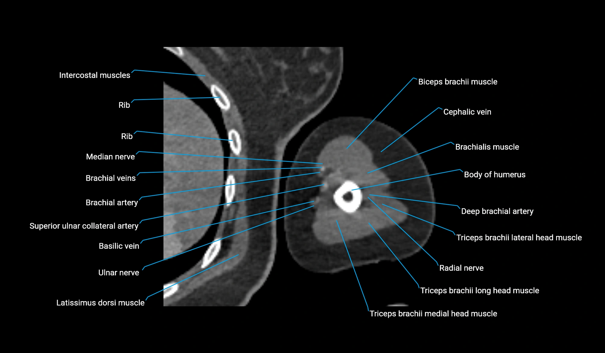 CT upper arm axial  cross sectional anatomy labelled radiology image -00272.webp